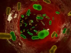 Blood Poisoning (Sepsis)