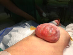 myelomeningocele spinal dysraphism congenital anomaly