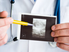 Intussusception of intestine in hepatic flexure of colon on ultrasound image concept photo. Doctor indicating by pen on printed picture ultrasound pathology. Photo for diagnosis, radiology, surgery