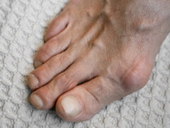 swelling of the joints of the toes. Painful gout inflammation on toe joints, selective focus. gouty toes of the womanâ€™s feet
