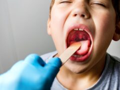The boy's mouth is wide open with tonsils are enlarged, visible in the white or yellowish tinge on a gray background. Pediatrician checking 8-aged schoolboy's throat applying wooden spatula.
