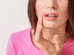 Young woman with cold sore on light background, closeup