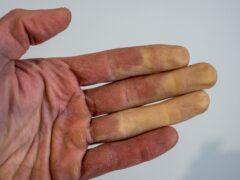 A frostbitten male hand with Raynaud's syndrome, Raynaud's phenomenon or Raynaud's disease.