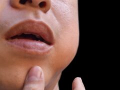 Swelling at the cheek of Asian young man. Inflammation of parotid gland called parotitis. Mumps.