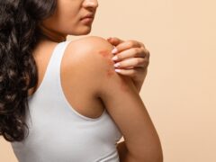 Unhappy young woman scratching her irritated skin on arm, annoyed indian female wearing white top suffering eczema or dermatitis, having itching rash on body, standing on beige studio background