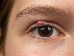 Chalazion on the eyelid of girl macro. Demodicosis mite diseas, demodex. Eye of girl with stye close-up. eye with swollen, inflamed eyelid. Eyelid abscess. Eye infection, hordeolum.