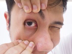 A close-up of a person checking a red, irritated eye, showing signs of conjunctivitis or eye infection. Ideal for medical, eye health, and vision-related content.