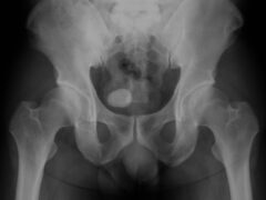 X-ray image of bladder, Showing bladder stone, A 41 year old male