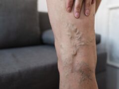 Closeup of a woman's varicose veins on the leg.